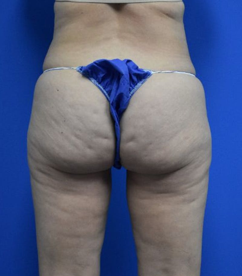 Thigh Lift Before & After Gallery - Patient 366129 - Image 3
