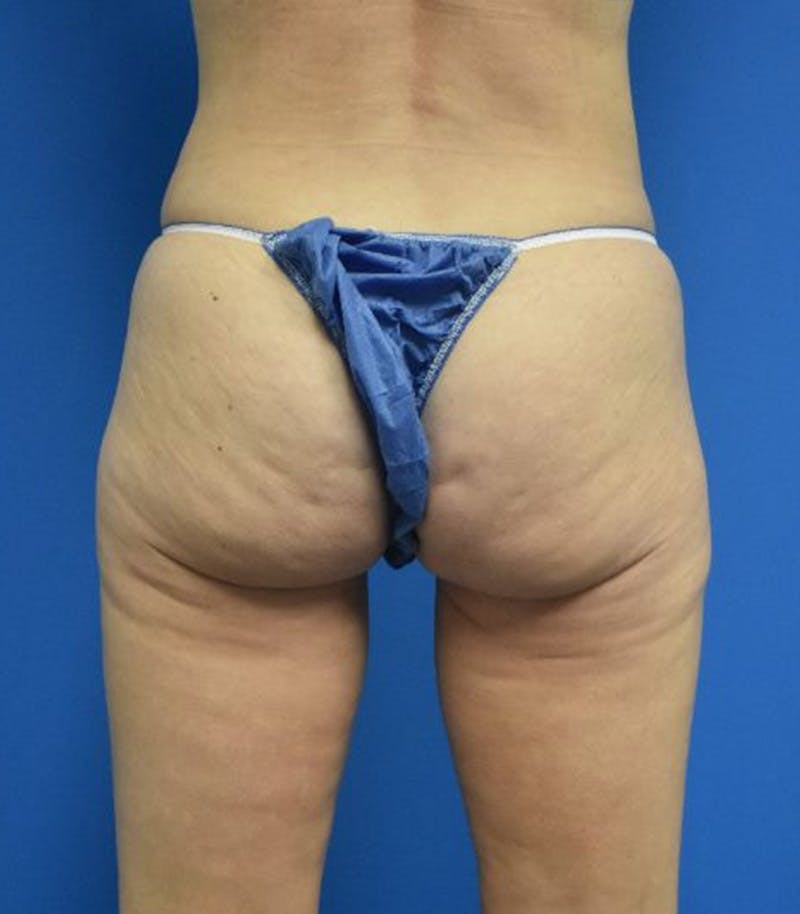 Thigh Lift Before & After Gallery - Patient 366129 - Image 4