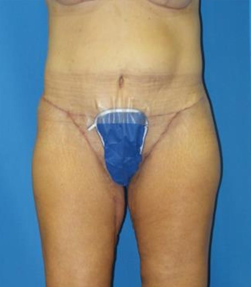 Thigh Lift Before & After Gallery - Patient 109901 - Image 2