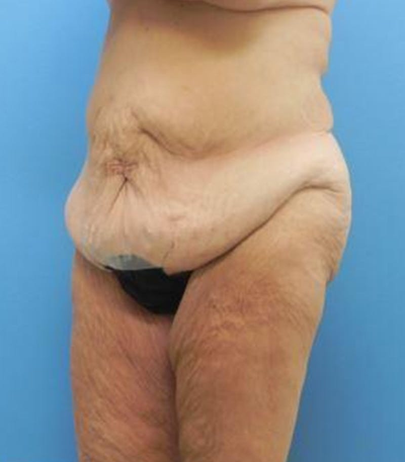 Thigh Lift Before & After Gallery - Patient 109901 - Image 3