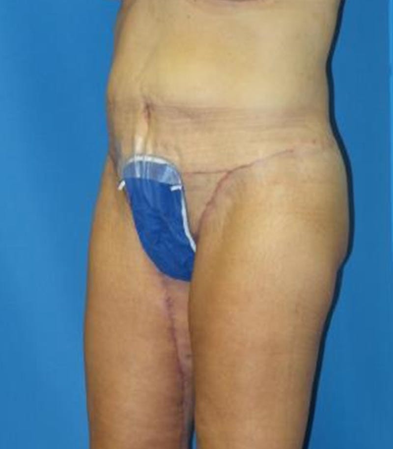 Thigh Lift Before & After Gallery - Patient 109901 - Image 4