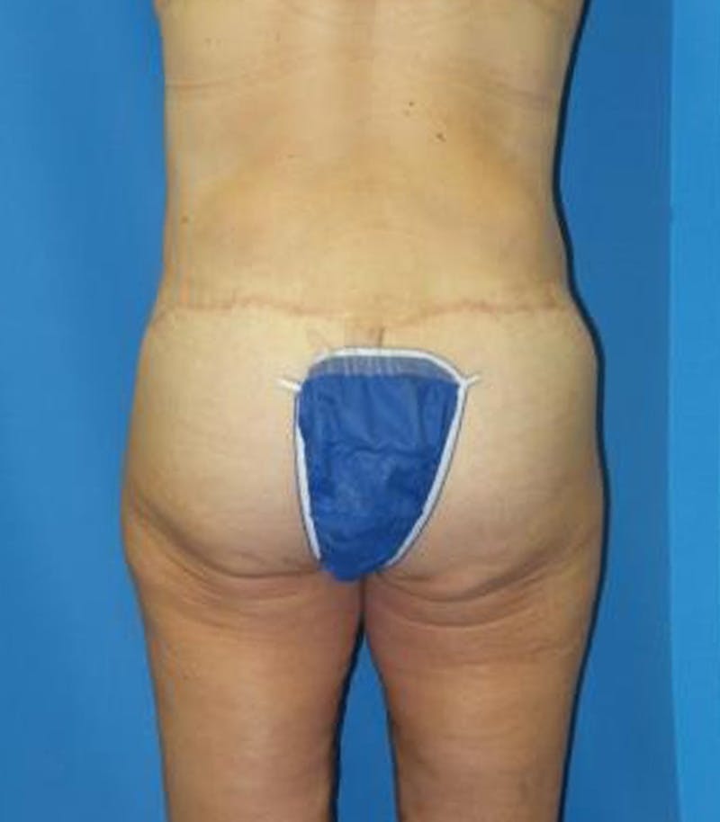 Thigh Lift Before & After Gallery - Patient 109901 - Image 6