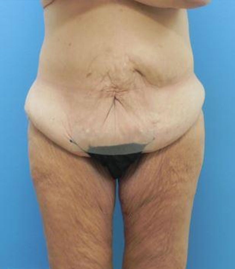 Thigh Lift Before & After Gallery - Patient 109901 - Image 1