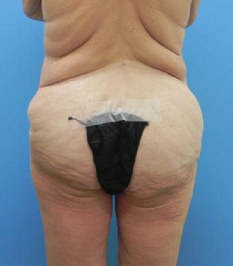 Thigh Lift Before & After Gallery - Patient 109901 - Image 5