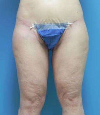 Thigh Lift Before & After Gallery - Patient 281283 - Image 2
