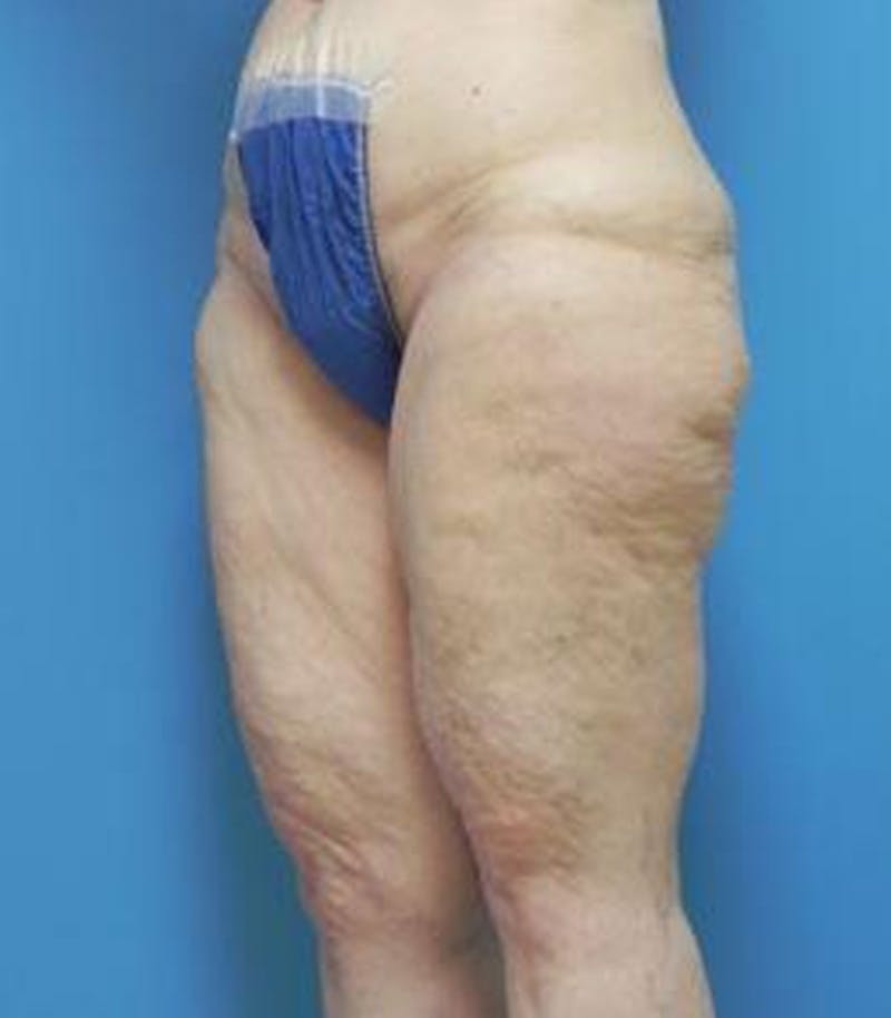 Thigh Lift Before & After Gallery - Patient 281283 - Image 3