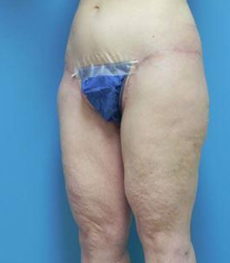 Thigh Lift Before & After Gallery - Patient 281283 - Image 4