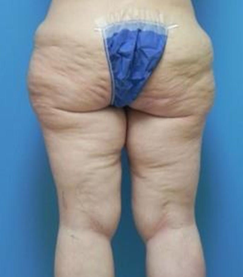 Thigh Lift Before & After Gallery - Patient 281283 - Image 5