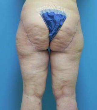Thigh Lift Before & After Gallery - Patient 654166 - Image 6