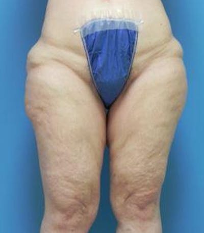 Thigh Lift Before & After Gallery - Patient 281283 - Image 1