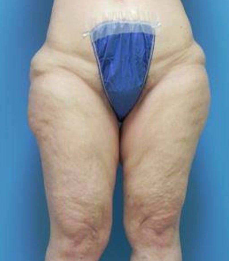 Thigh Lift Before & After Gallery - Patient 281283 - Image 1