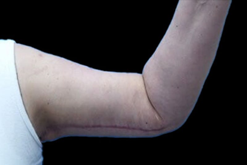 Brachioplasty Before & After Gallery - Patient 251706 - Image 4