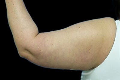 Brachioplasty Before & After Gallery - Patient 251706 - Image 1