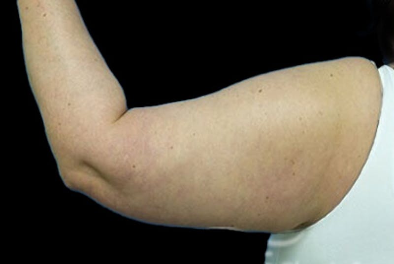 Brachioplasty Before & After Gallery - Patient 251706 - Image 1