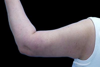 Brachioplasty Before & After Gallery - Patient 251706 - Image 2