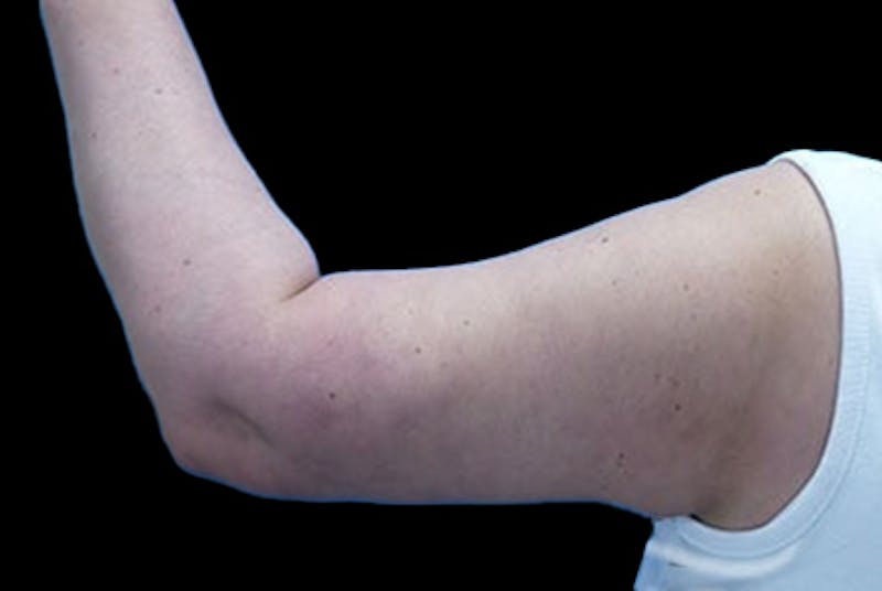 Brachioplasty Before & After Gallery - Patient 251706 - Image 2