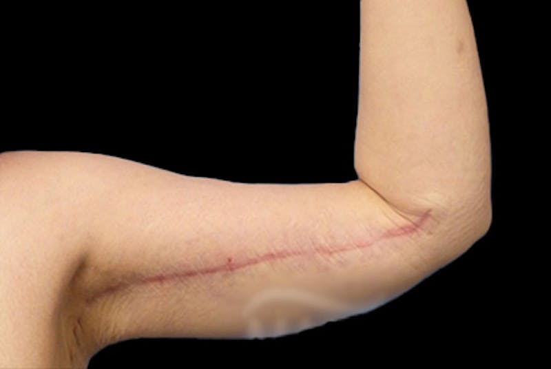 Brachioplasty Before & After Gallery - Patient 169959 - Image 4