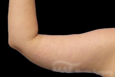 Brachioplasty Before & After Gallery - Patient 169959 - Image 2