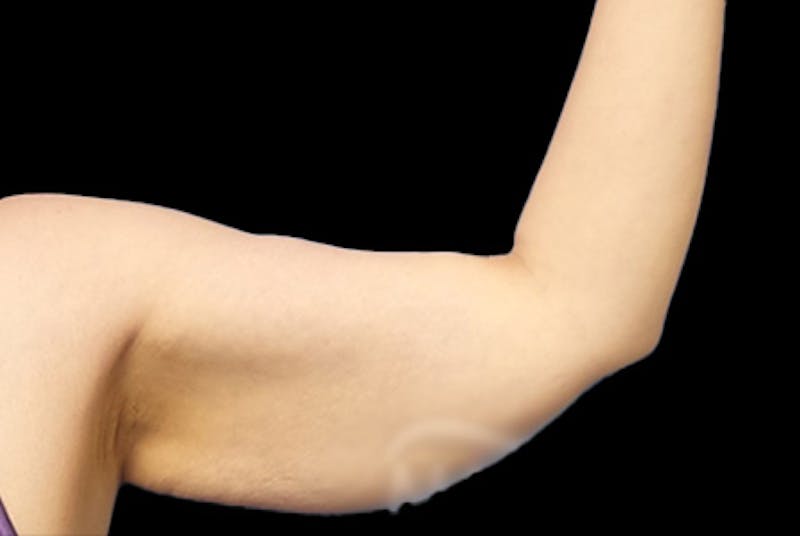 Brachioplasty Before & After Gallery - Patient 169959 - Image 3