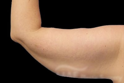 Brachioplasty Before & After Gallery - Patient 169959 - Image 1