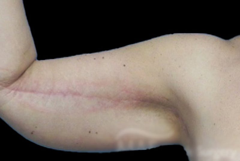Brachioplasty Before & After Gallery - Patient 327994 - Image 4