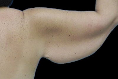 Brachioplasty Before & After Gallery - Patient 327994 - Image 1