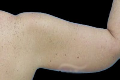 Brachioplasty Before & After Gallery - Patient 327994 - Image 2