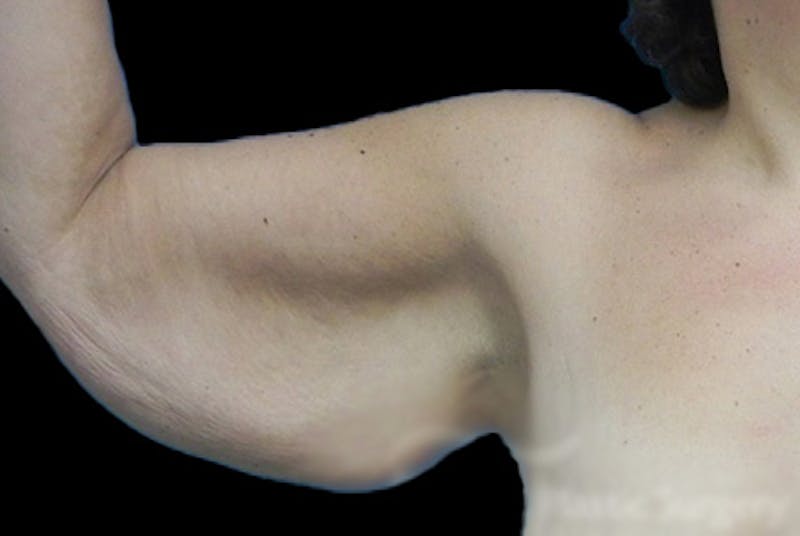 Brachioplasty Before & After Gallery - Patient 327994 - Image 3
