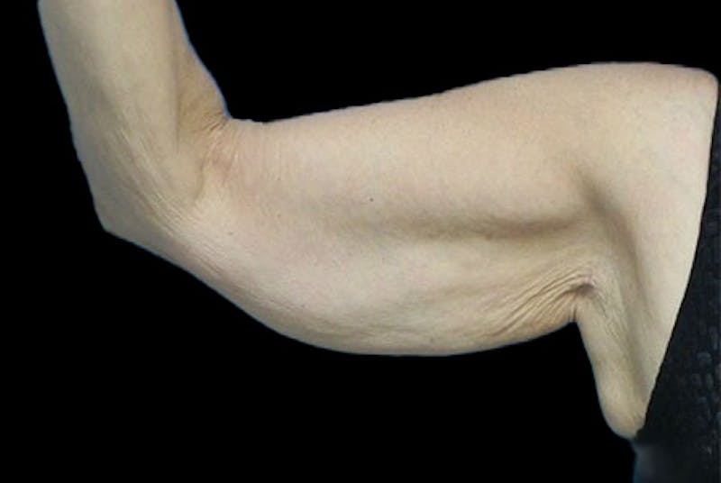 Brachioplasty Before & After Gallery - Patient 259095 - Image 3