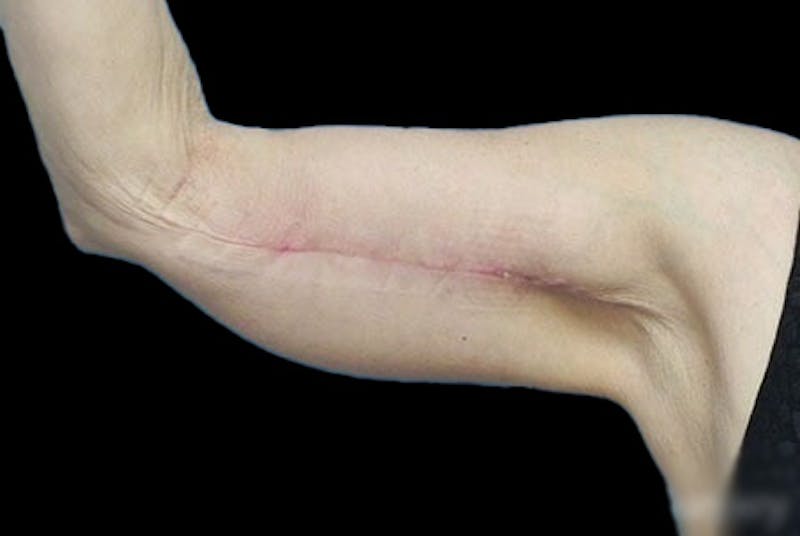 Brachioplasty Before & After Gallery - Patient 259095 - Image 4