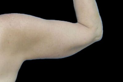 Brachioplasty Before & After Gallery - Patient 259095 - Image 2