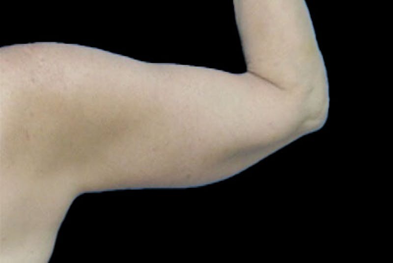 Brachioplasty Before & After Gallery - Patient 259095 - Image 2
