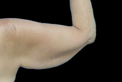 Brachioplasty Before & After Gallery - Patient 259095 - Image 1