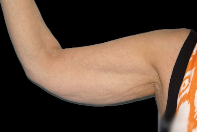 Brachioplasty Before & After Gallery - Patient 266370 - Image 3