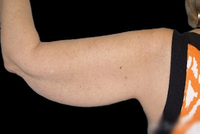 Brachioplasty Before & After Gallery - Patient 266370 - Image 1