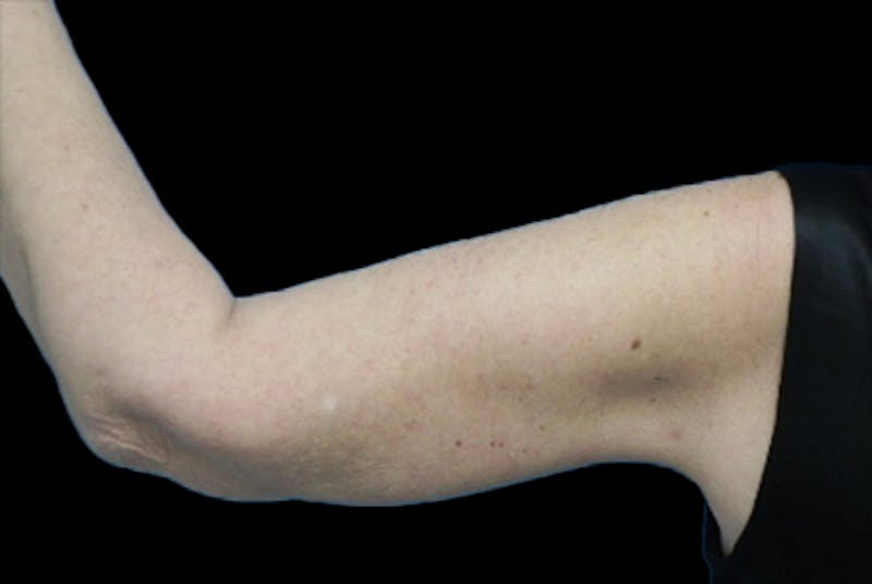 Brachioplasty Before & After Gallery - Patient 266370 - Image 2