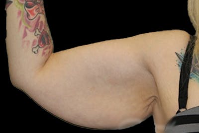 Brachioplasty Before & After Gallery - Patient 288877 - Image 1