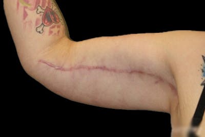 Brachioplasty Before & After Gallery - Patient 288877 - Image 2