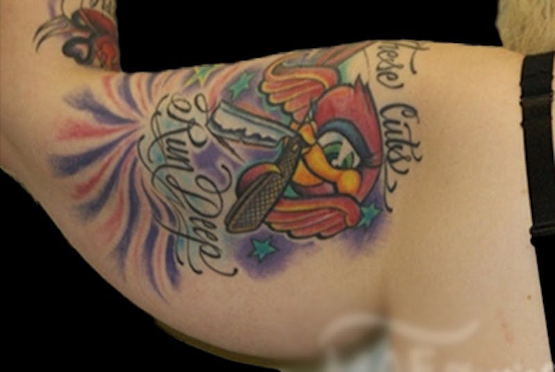 Brachioplasty Before & After Gallery - Patient 288877 - Image 3