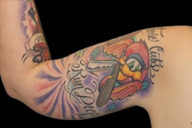 Brachioplasty Before & After Gallery - Patient 288877 - Image 4