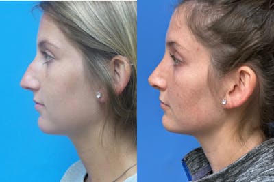 Rhinoplasty Before & After Gallery - Patient 178031 - Image 1