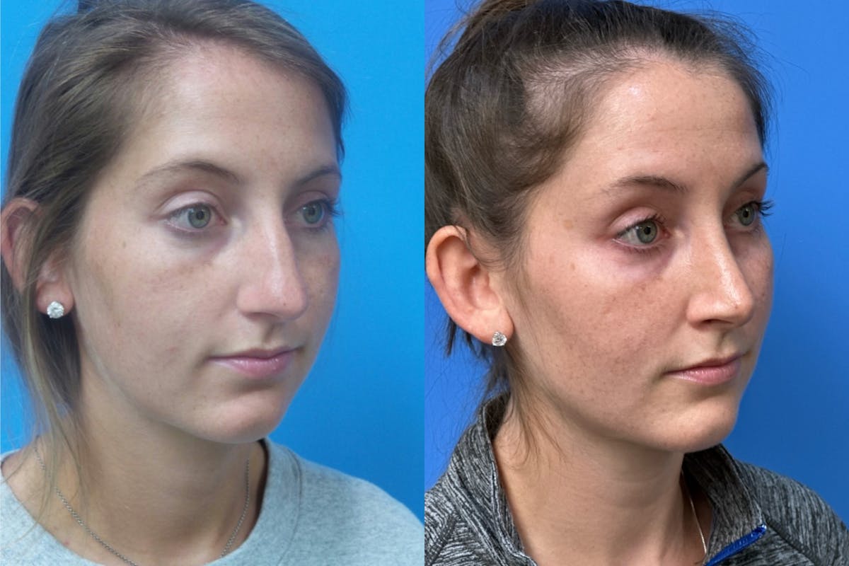 Rhinoplasty Before & After Gallery - Patient 178031 - Image 2