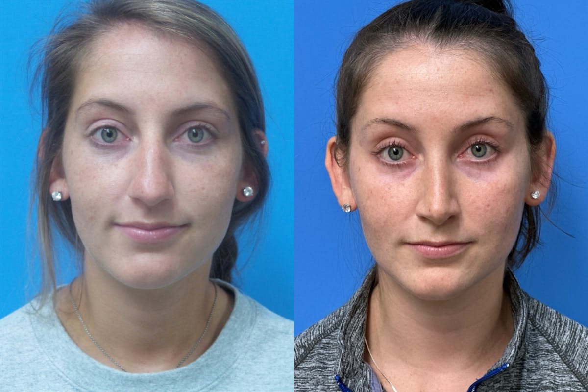 Rhinoplasty Before & After Gallery - Patient 178031 - Image 3