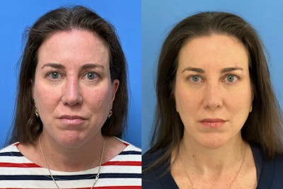 Neck Lift Before & After Gallery - Patient 131768 - Image 1