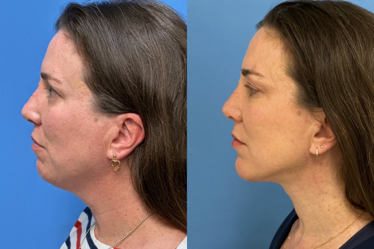 Neck Lift Before & After Gallery - Patient 131768 - Image 3