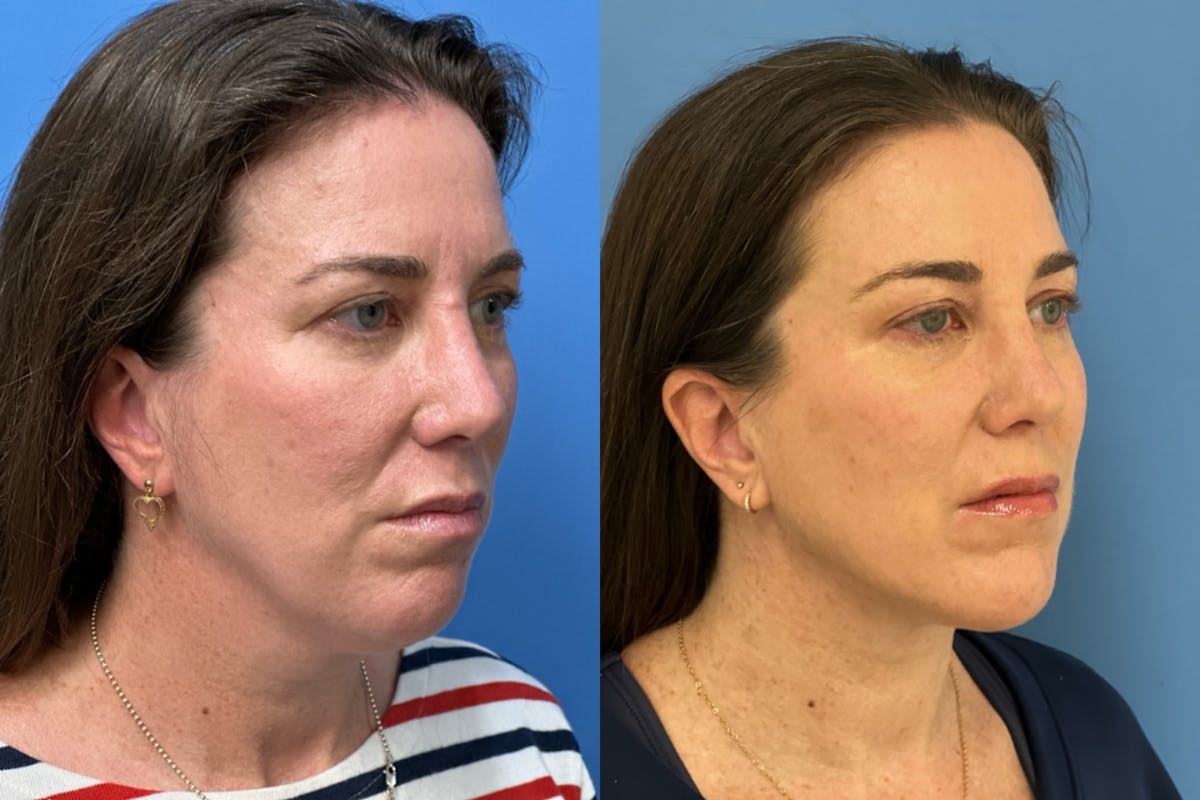 Neck Lift Before & After Gallery - Patient 131768 - Image 2