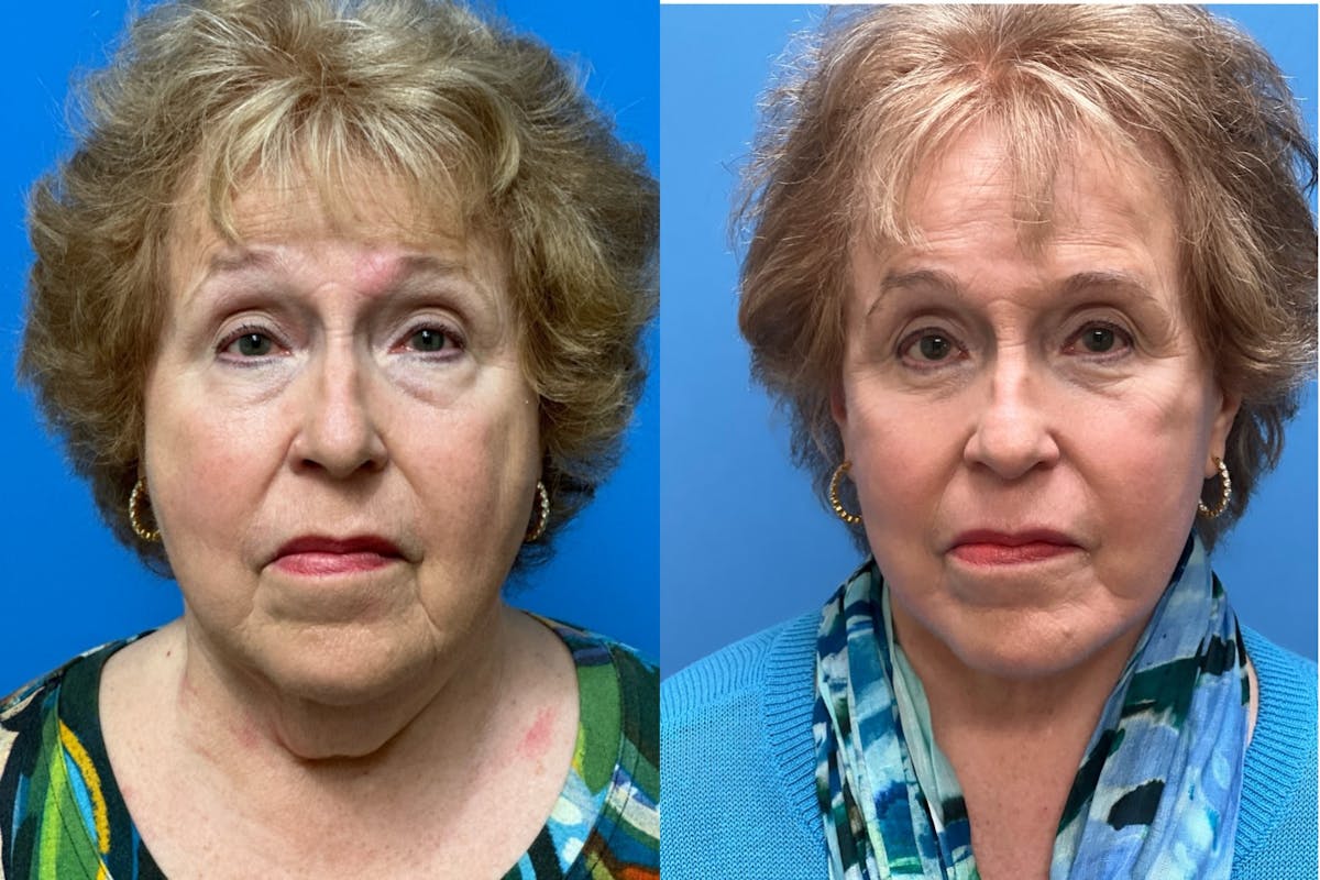 Facelift Before & After Gallery - Patient 168051 - Image 1