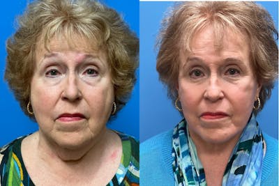 Facelift Before & After Gallery - Patient 168051 - Image 1