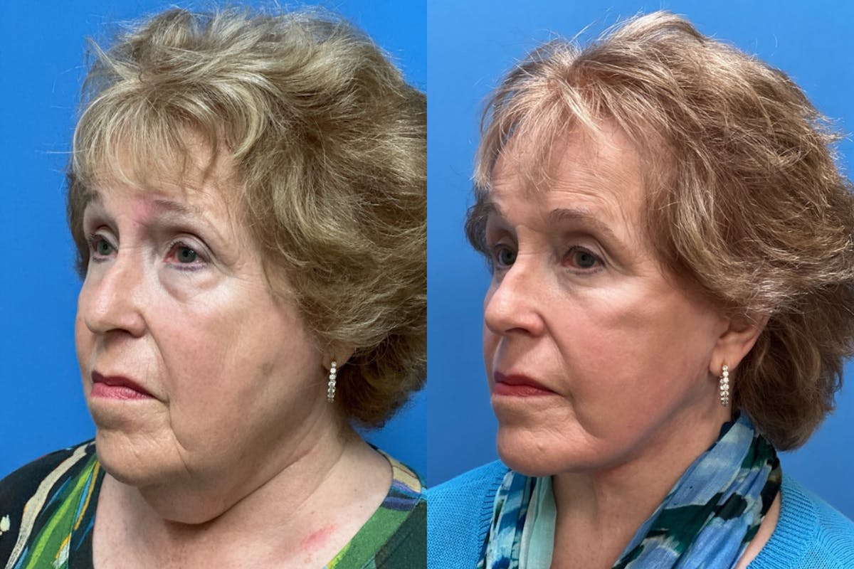 Facelift Before & After Gallery - Patient 168051 - Image 2