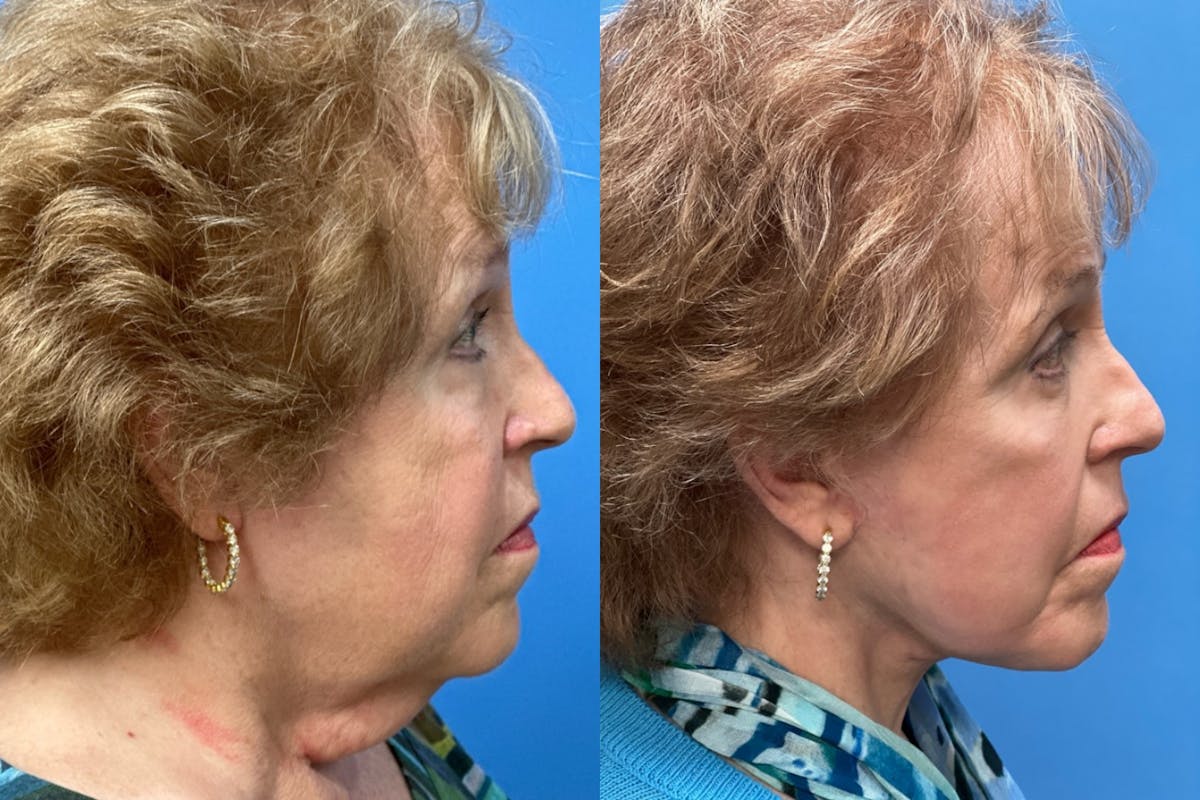 Facelift Before & After Gallery - Patient 168051 - Image 3